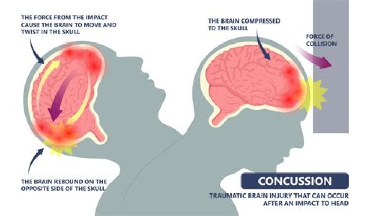 Can TBI affect you years later?