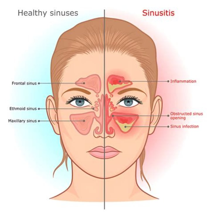 What causes sinus problems in summer?