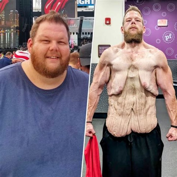 Will my skin sag if I lose 100 pounds?